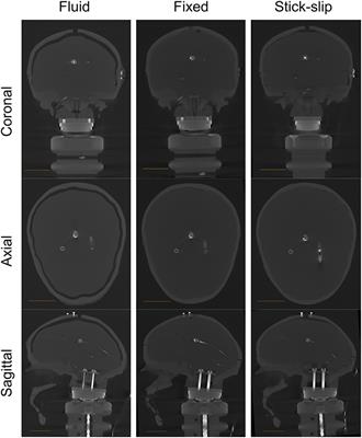 Role of Interfacial Conditions on Blast Overpressure Propagation Into the Brain